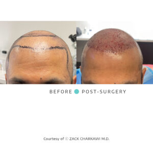 Before and after images of FUT and FUE hair transplant procedures
