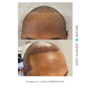 Before and after images of FUT or FUE hair transplant procedures
