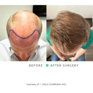 Before and after images of FUT or FUE hair transplant procedures