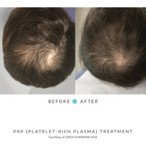 prp platelet-rich-plasma results