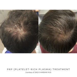 prp platelet-rich-plasma results